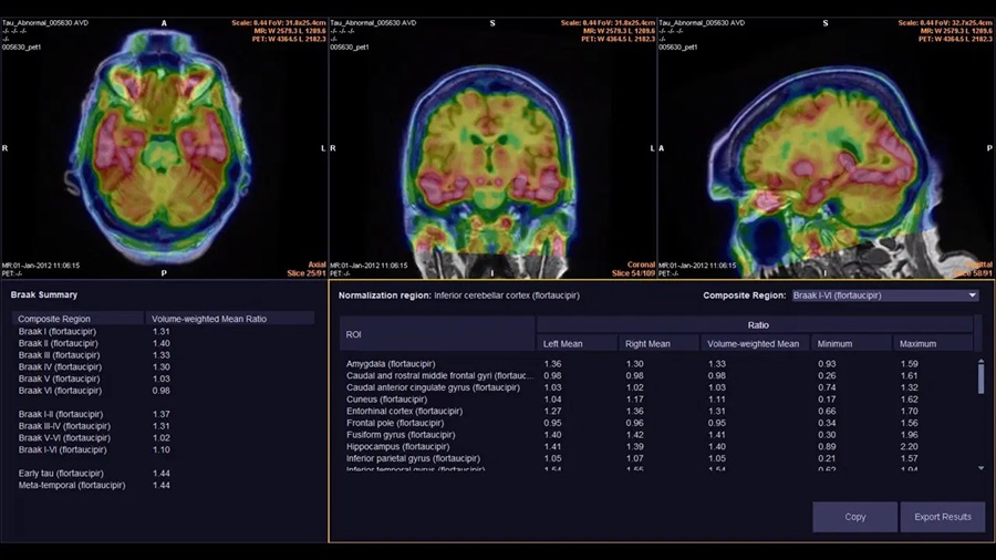 Image: syngo.PET Cortical Analysis software enables the measurement of beta-amyloid and tau protein deposits in the brain (Photo courtesy of Siemens Healthineers)